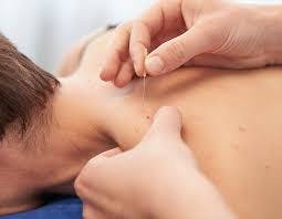 Dry Needling in Physical Therapy