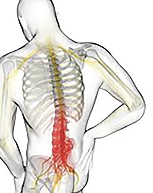 Low Back Pain