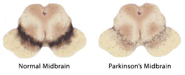 Normal Midbrain vs. Parkinson's Midbrain