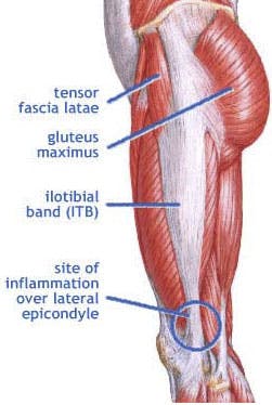 Top 5 Running Injuries: Iliotibial Band Syndrome