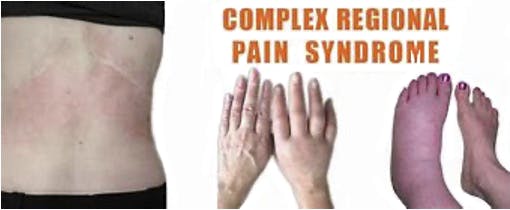 Complex Regional Pain Syndrome | CRPS