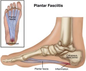 Good feet deals plantar fasciitis