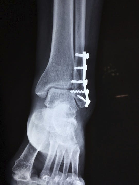 Foot and Ankle Stress Fractures