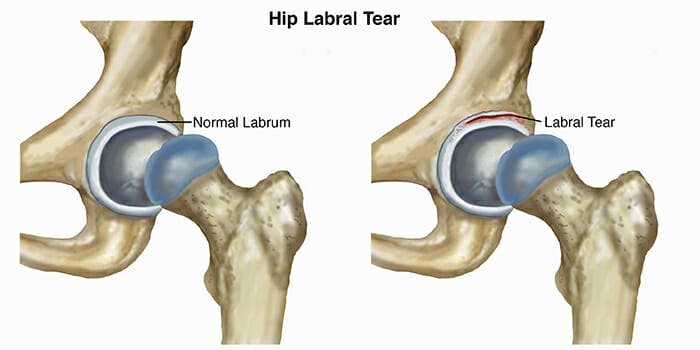 Labral Tear - Hip Pain