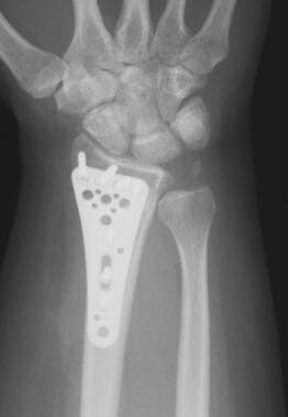 Distal Radius Fracture with Metal Plate and Screws