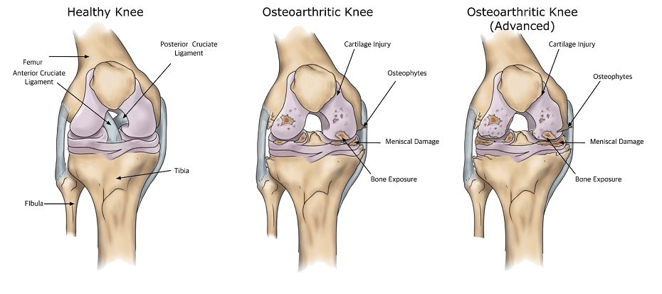 osteoarthritis knee joint