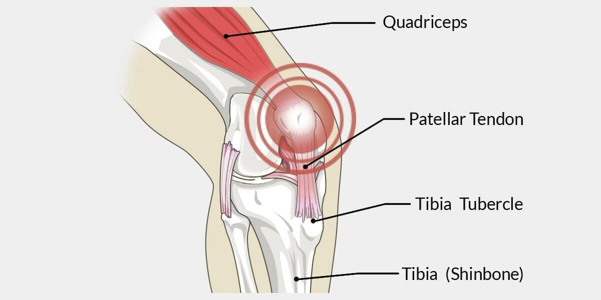 patellar tendonitis