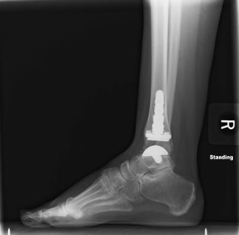 Post Surgical x-ray of Total Ankle Replacement