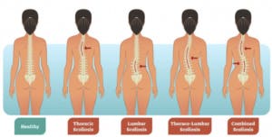 Types of Scoliosis Graphic