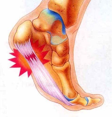 Plantar fasciitis hot sale therapy exercises