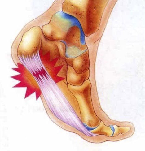 Physical Therapy Exercises for Plantar Fasciitis - 1st Choice Physical  Therapy