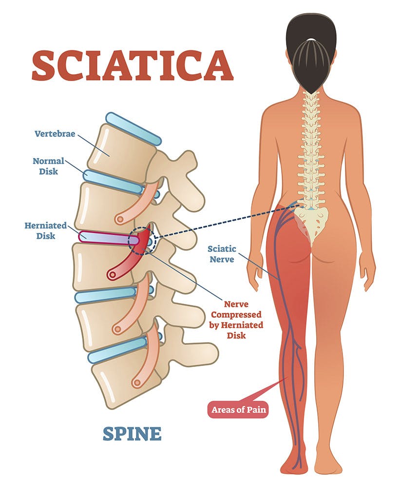 Back Pain Sciatica Bergenfield Physical Therapy Pain Management