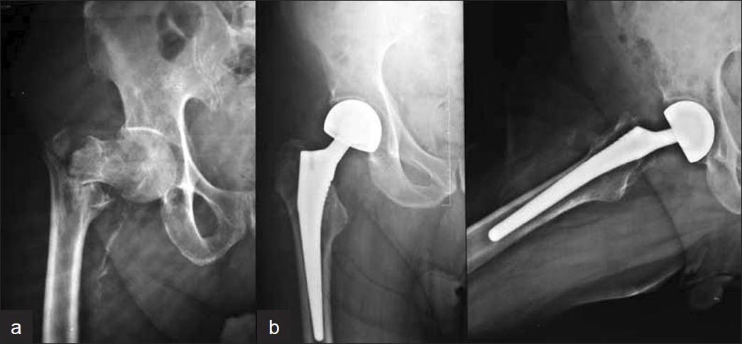 Hip fracture and THR