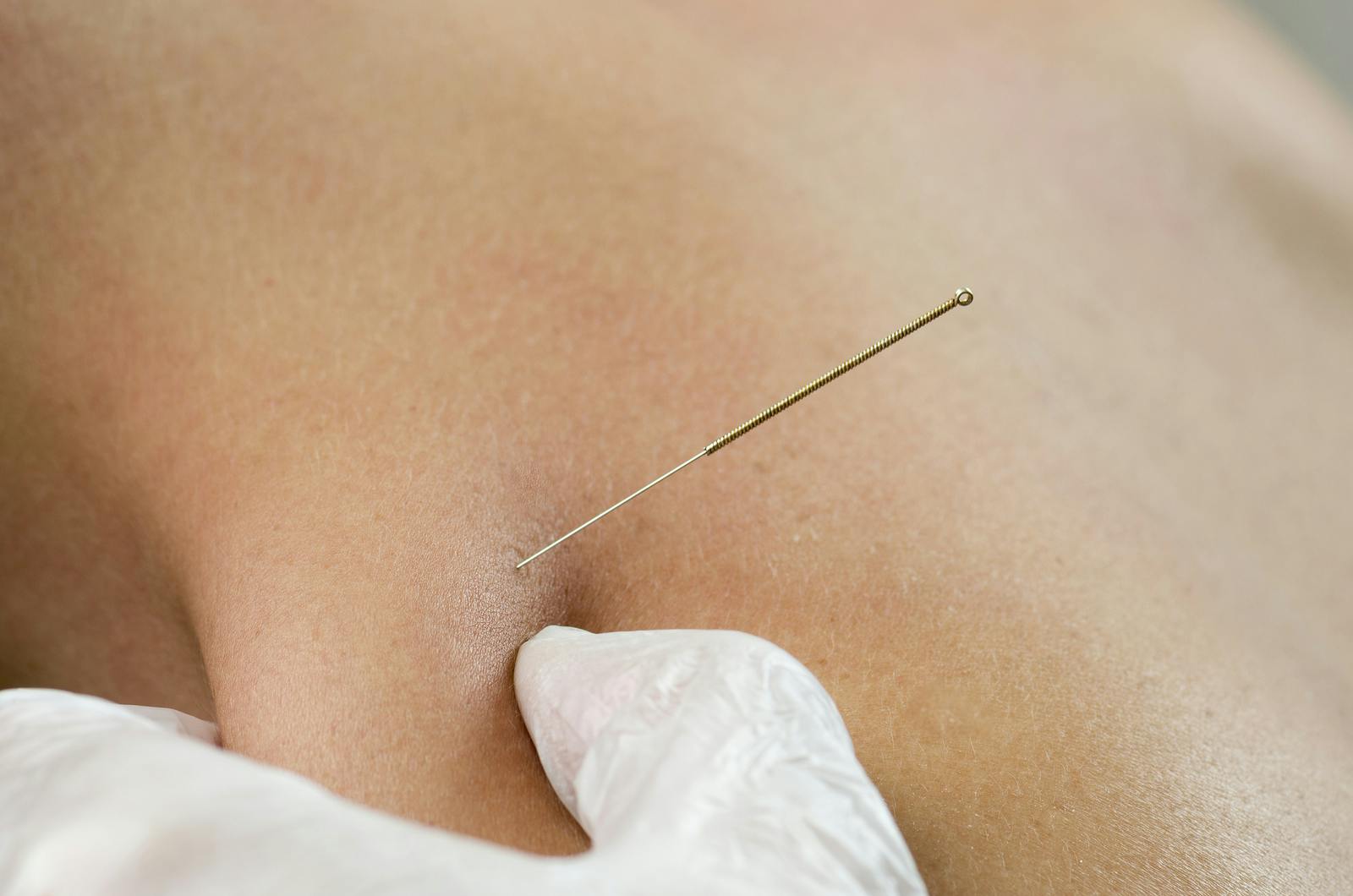 Dry Needling is also known as intramuscular stimulation (IMS) and trigger  point dry needling (TDN). It is a safe, effective and efficient treatment  used to: