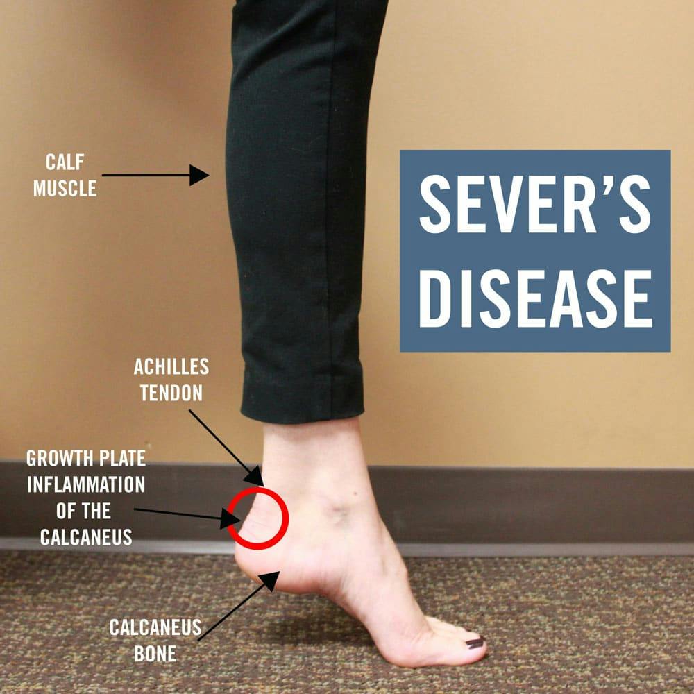sever's disease heel support