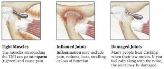 Temporomandibular Joint | TMJ