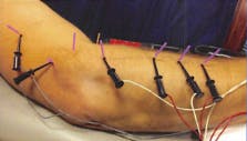Premier Rehab Physical Therapy | Electrical Dry Needling Protocol - lateral epicondylitis