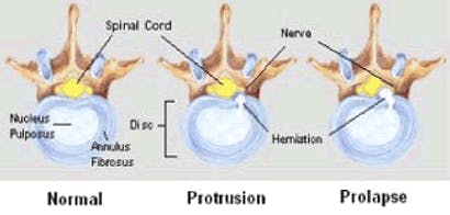 Physical Therapy for Neck and Back Pain - Texas-Neuro Spine Surgery