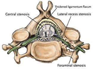 Spinal Stenosis