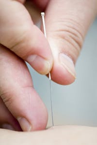 InMotion Physical Therapy | Trigger Point Dry Needling