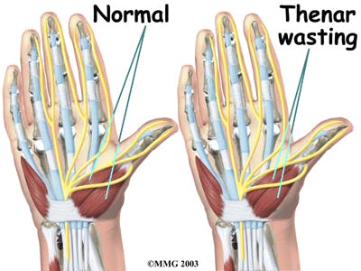 Diagram of Thenar Wasting - Atrophy