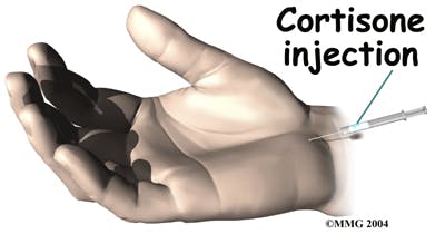 Diagram of Cortisone Injection