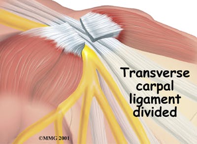 Dividing Transverse Carpal Ligament