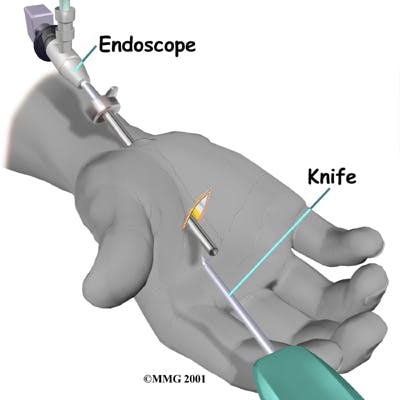 Diagram of Endoscopic Release