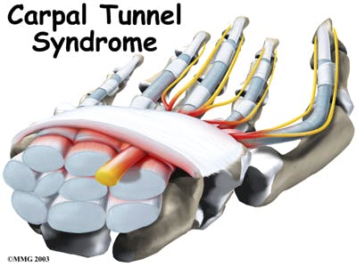 Diagram of Carpal Tunel Syndrome | CTS