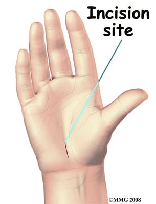 Diagram of Incision Site