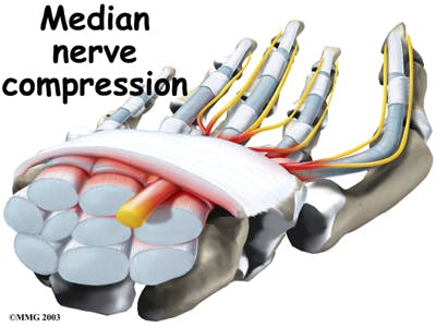 Diagram of Median Nerve Compression