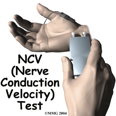 Diagram of Nerve Conduction Velocity (NCV) Test