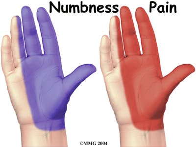 Numbness and Pain in Hand