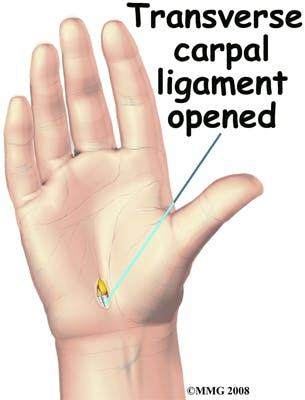 Transverse Carpal Ligament Opened