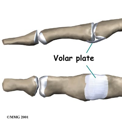 Diagram of Volar Plate