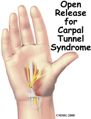 Open Release for Carpal Tunnel Syndrome | CTS