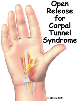 Open Release for Carpal Tunnel Syndrome | CTS
