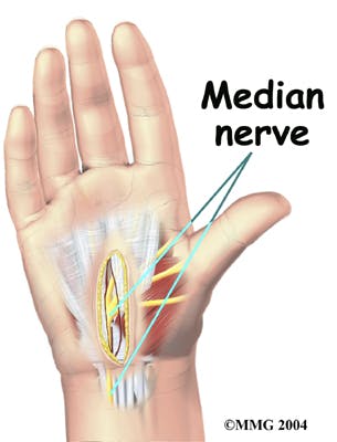 Diagram of Median Nerve Protected