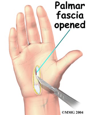 Diagram of Palmar Fascia Exposed