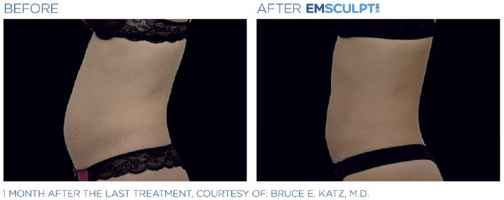 Before & After photo of lady's belly - side view