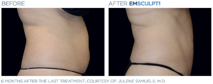 Before & After photo of a lady's belly - side view