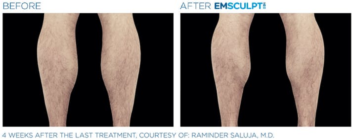 Before & After photo of a man's calves - side view