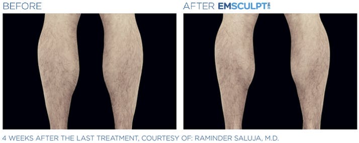 Before & After photo of a man's calves - side view