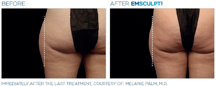 Before & After photo of someone's buttocks - saddlebags