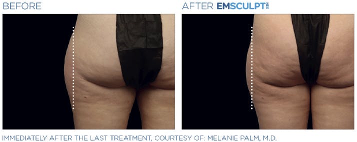 Before & After photo of someone's buttocks - saddlebags