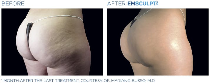 Before & After photo of a lady's buttocks - angled view