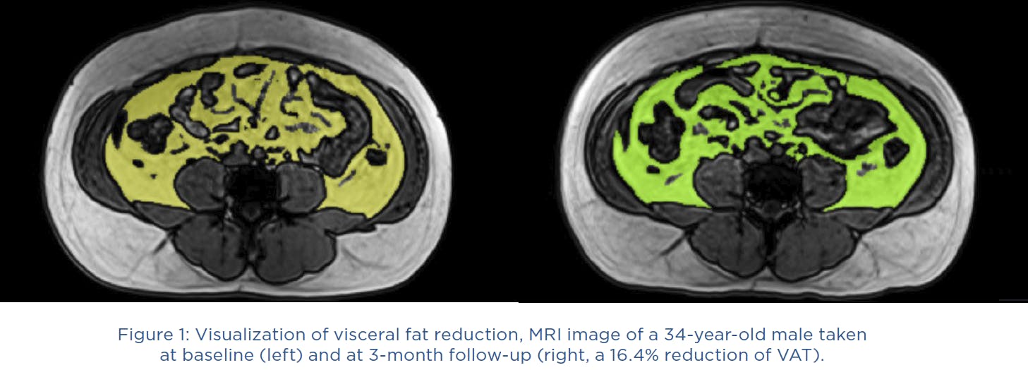 Visceral Fat Diagram showing MRI of a 34-year-old-male