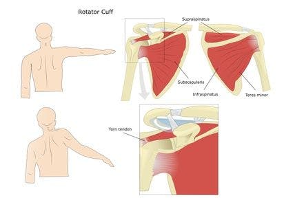 rotator cuff tear diagnosis