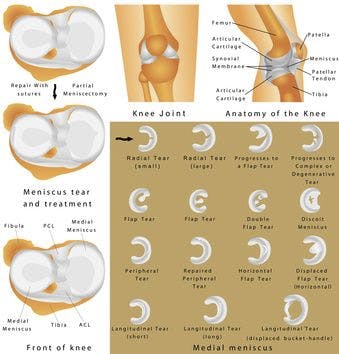 Diagram of maniscus tears in the knee