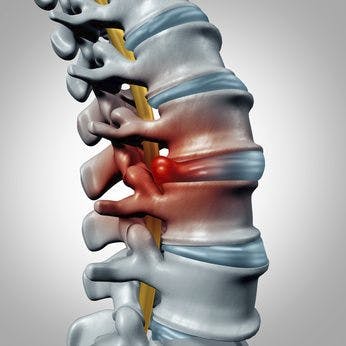 Disc Pain | Disc Herniation Physical Therapy